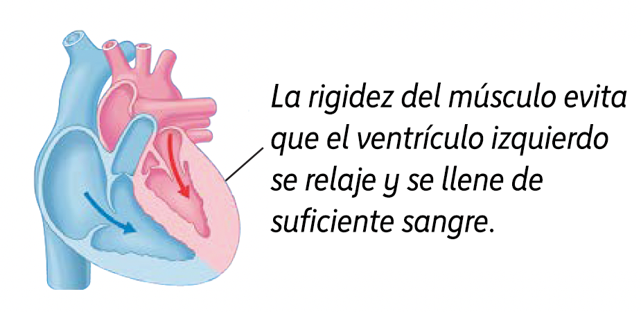 La insuficiencia cardíaca con fracción de eyección preservada