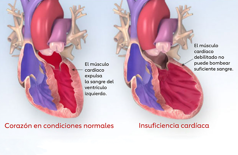 un corazón normal y un corazón con insuficiencia cardíaca