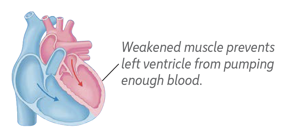 Heart with Reduced Ejection Fraction