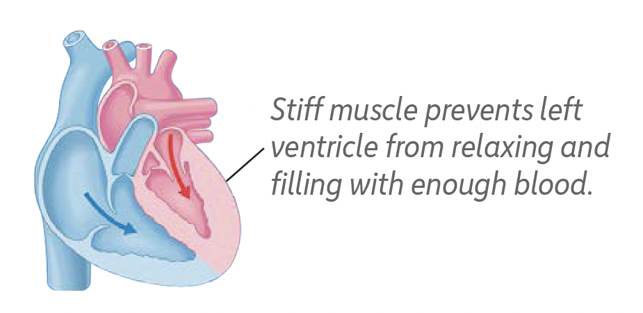 Heart with Preserved Ejection Faction