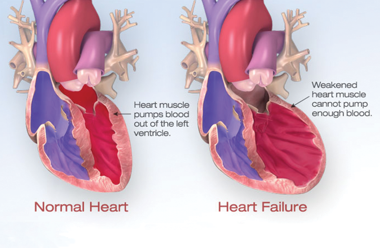 one normal heart and one heart with heart failure